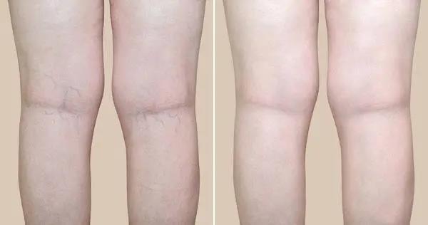 人老腳先衰，木枯根先竭，艾灸不能忘了灸腿！