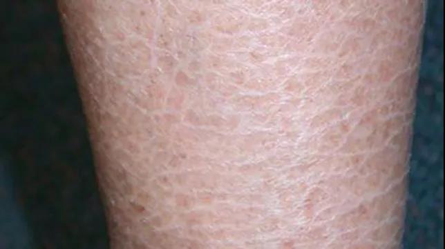 魚鱗皮膚是缺水表現(xiàn)嗎，問題出在這里